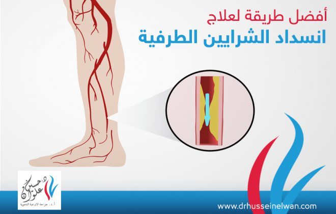 افضل طريقة لعلاج انسداد الشرايين الطرفية 4 افضل طريقة لعلاج انسداد الشرايين