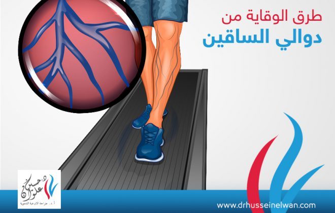 طرق الوقاية من دوالي الساقين 2 اهم طرق الورقاية من دوالي الساقين