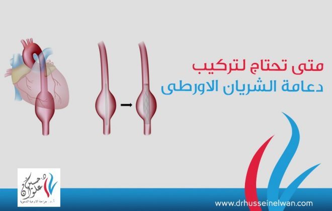 متي تحتاج لتركيب دعامة الشريان الاورطي 3 دعامة الشريان الاورطي