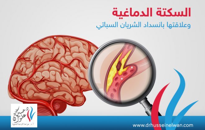 السكتة الدماغية وعلاقتها بانسداد الشريان السباتي 2 السكتة الدماغية وعلاقتها بانسداد الشريان السباتي