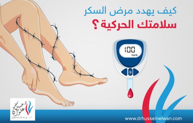 كيف يهدد مرض السكر سلامتك الحركية و يهدد ساقك ؟ 3 القدم السكري