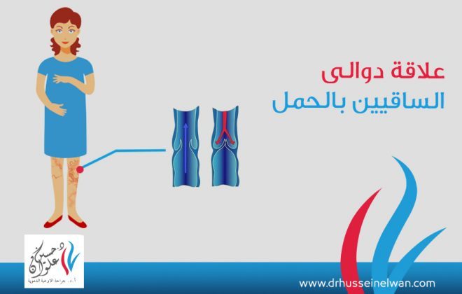 علاقة دوالي الساقين بالحمل 4 علاقة دوالي الساقين بالحمل