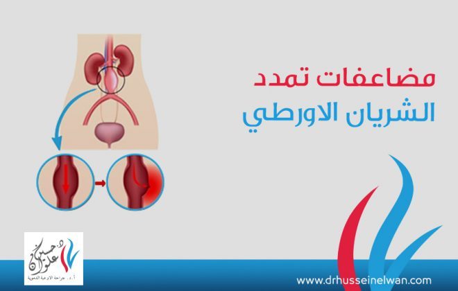مضاعفات تمدد الشريان الاورطي التي تنذر بالخطر 2 مضاعفات تمدد الشريان الاورطي