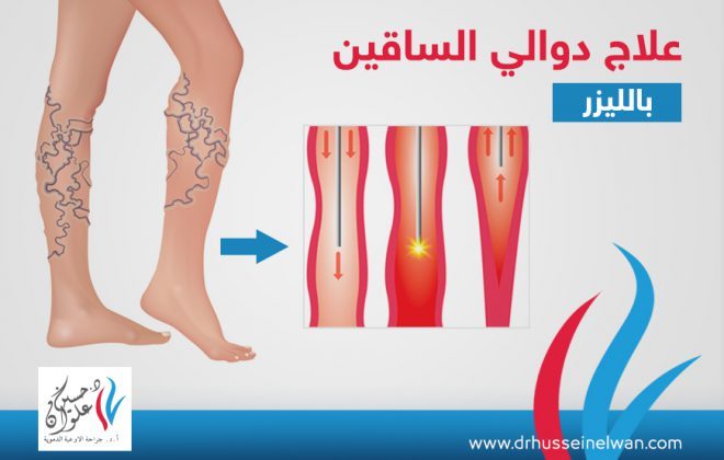 هذه هي طرق علاج الدوالي بالليزر 3 علاج دوالي الساقين بالليزر