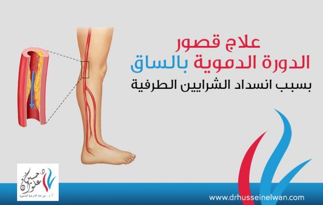 ما لا تعرفه عن قصور الدوره الدمويه بالساق بسبب انسداد الشرايين الطرفيه 6 انسداد الشرايين