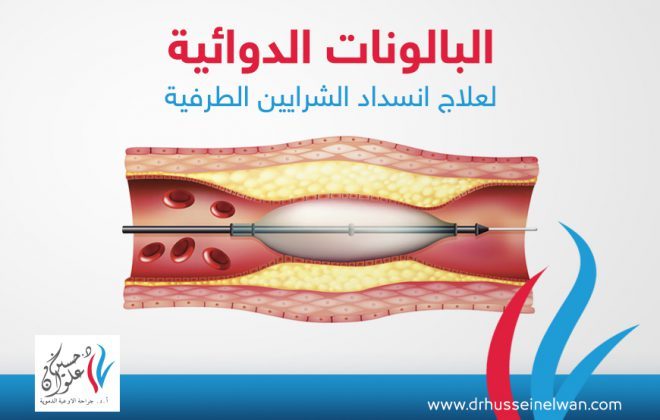 البالونات الدوائيه لعلاج انسداد الشرايين الطرفيه 2 البالونات الدوائية لعلاج انسداد الشرايين