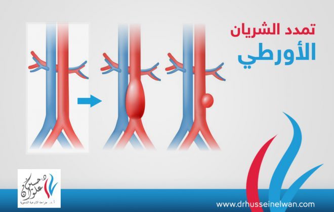 تمدد الشريان الاورطي 2 تمدد الشريان الاورطي