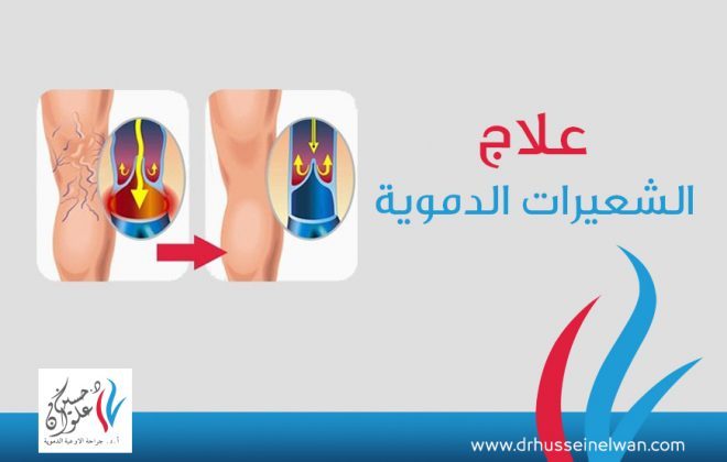 علاج الشعيرات الدمويه 4 علاج الشعيرات الدموية