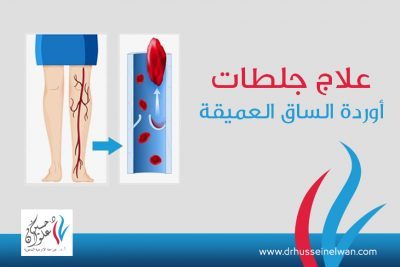 علاج جلطات أوردة الساق