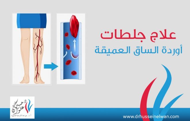 علاج جلطات أوردة الساق