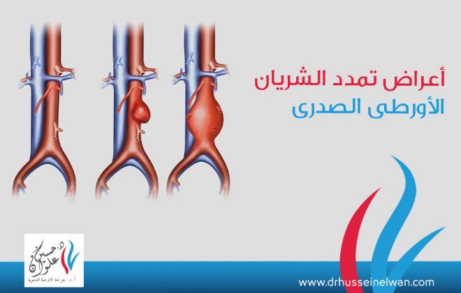 اعراض تمدد الشريان الاورطي الصدري 2 اعراض تمدد الشريان الاورطي الصدري