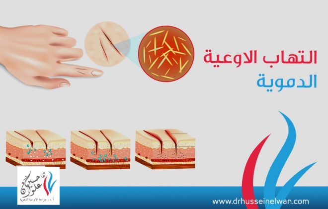 التهاب الاوعية الدموية.. الأعراض والأسباب وطريق العلاج 6 التهاب الاوعية الدموية