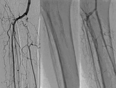 استخدام الدعامات الطرفيه في علاج ضيق شرايين الساق 9 Untitled 13
