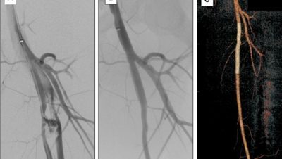 استخدام الدعامات الطرفيه في علاج ضيق شرايين الساق 12 Untitled 15
