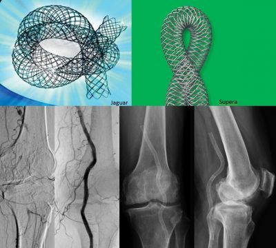 استخدام الدعامات الطرفيه في علاج ضيق شرايين الساق 7 Untitled 18