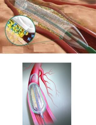 توسيع شريان الساق عن طريق البالونه الدوائيه 2 Untitled 22