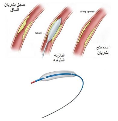 توسيع الشريان عن طريق البالونه الطرفيه 2 Untitled 24