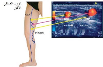 دور قسطره الليزر في علاج دوالي الاورده الاساسيه 4 Untitled 27