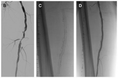 استخدام الدعامات الطرفيه في علاج ضيق شرايين الساق 3 Untitled 5