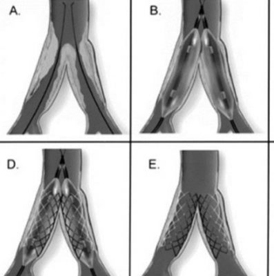 استخدام الدعامات الطرفيه في علاج ضيق شرايين الساق 5 Untitled 7