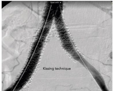 استخدام الدعامات الطرفيه في علاج ضيق شرايين الساق 6 Untitled 8