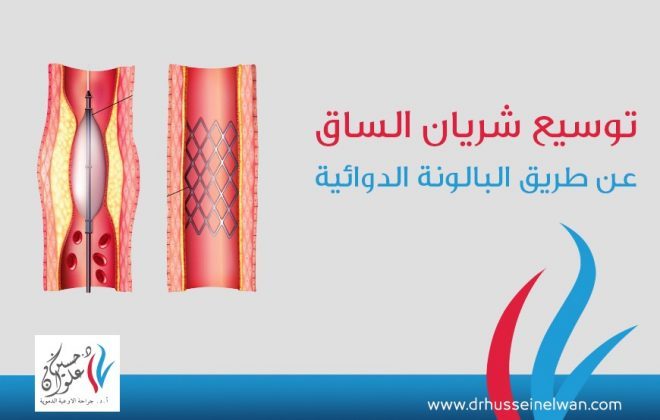توسيع شريان الساق عن طريق البالونه الدوائيه 7 WhatsApp Image 2021 06 16 at 4.04.01 PM