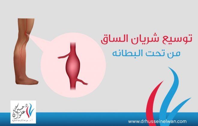 توسيع شريان الساق من تحت البطانه 5 WhatsApp Image 2021 06 16 at 4.04.01 PM1