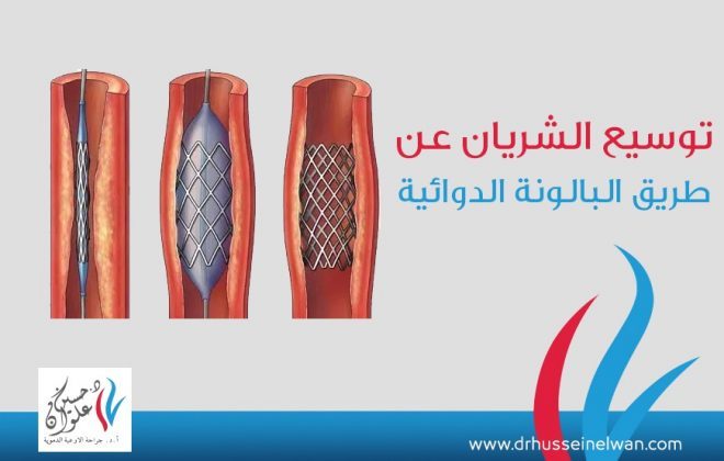 توسيع الشريان عن طريق البالونه الطرفيه 3 WhatsApp Image 2021 06 17 at 12.02.37 PM