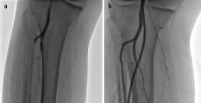 استخدام دواد الاذابه لتسليك شرايين الساق 2 سشيس