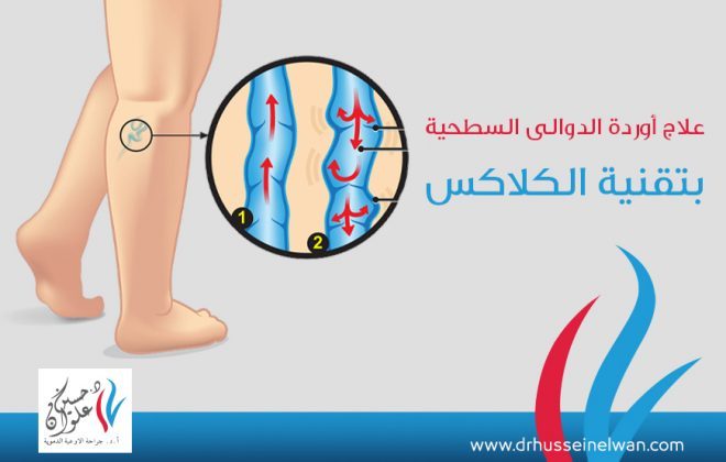 علاج أوردة الدوالي السطحيه بتقنية "كلاكس" 3 علاج أوردة الدوالي السطحيه بتقنية كلاكس