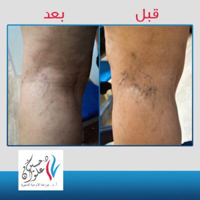 تعرف على تقنية الكلاكس : أحدث طرق علاج الشعيرات الدمويه 2 6 1