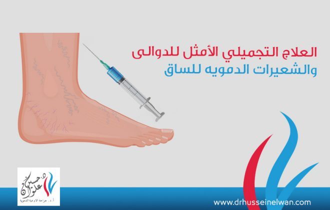 لأول مره في مصر"الكلاكس” العلاج التجميلي الأمثل للدوالي والشعيرات الدمويه للساق 2 تجميل الدوالي و الشعيرات