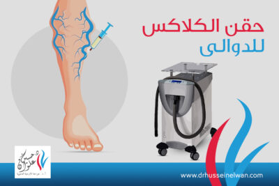تقنية الكلاكس في علاج الدوالي تقنية الكلاكس في علاج الدوالي