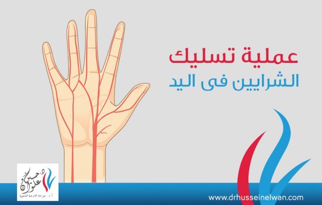 انسداد الشرايين الطرفية في اليدين و عملية تسليك شرايين اليد 2 عملية تسليك شرايين اليد