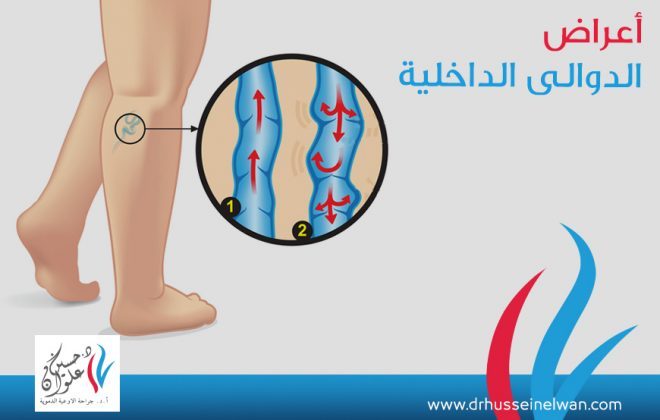 اعراض الدوالي الداخلية وعلاجها 2 اعراض الدوالي الداخلية