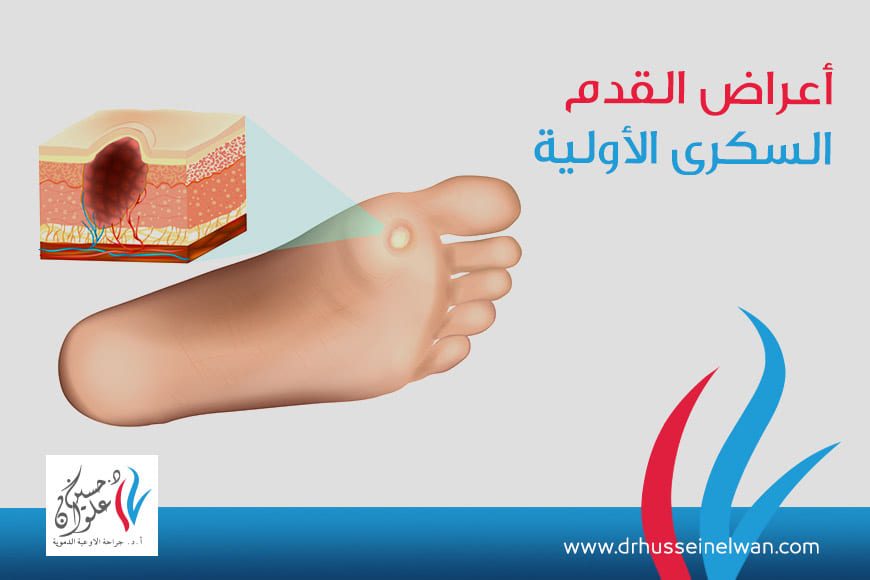 رقمي لاسلكي حبيبي  أعراض القدم السكري الأولية - الدكتور حسين علوان