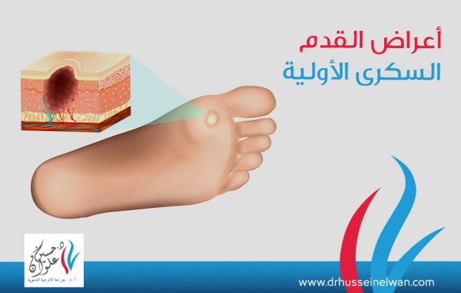 أعراض القدم السكري الأولية 2 أعراض القدم السكري الأولية