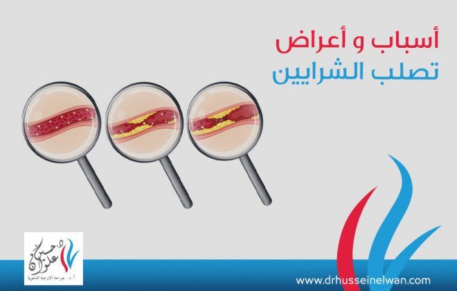 أسباب واعراض تصلب الشرايين 4 أسباب واعراض تصلب الشرايين