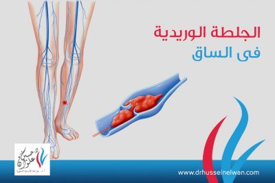 ما هى علامات الجلطة الوريدية في الساق؟