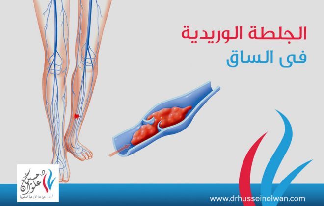 ما هى علامات الجلطة الوريدية في الساق؟ 6 ما هى علامات الجلطة الوريدية في الساق؟