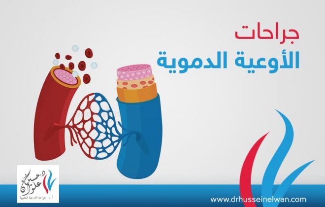 جراحة اوعية دموية 4 ما هي جراحة الاوعية الدموية عيادة جراحة الاوعية الدموية