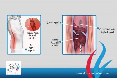 أمراض-الأوعية-الدموية-copy دور القسطره في علاج أورده الساق العميقه