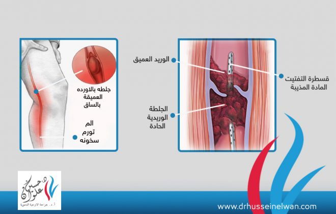 دور القسطره في علاج أورده الساق العميقه 3 دور القسطره في علاج أورده الساق العميقه