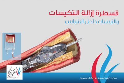 قسطرة-ازالة-لتكيسات-و-الترسبات-داخل-الشرايين قسطره ازاله التكيسات والترسبات داخل الشرايين "Jetstream ”