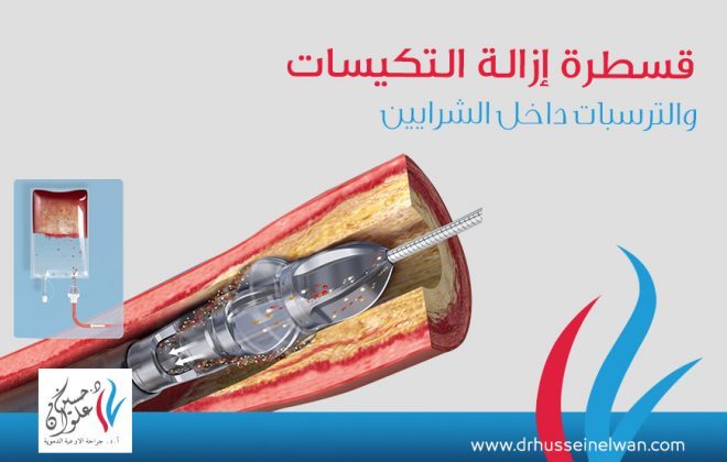 قسطره ازاله التكيسات والترسبات داخل الشرايين 4 قسطره ازاله التكيسات والترسبات داخل الشرايين "Jetstream ”