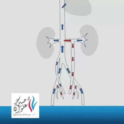 ما هي دوالي الحوض؟ 
