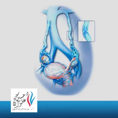 ما هي دوالي الحوض؟ 