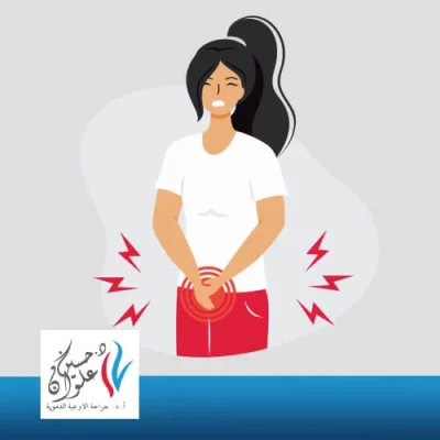 ما هي اعراض دوالي الحوض؟ 