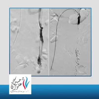ما هو علاج دوالي الحوض؟ 
